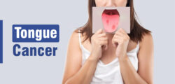 Рак язика: як розпізнати та вилікувати захворювання?